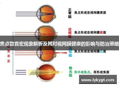 焦点致盲宏现象解析及其对视网膜健康的影响与防治策略